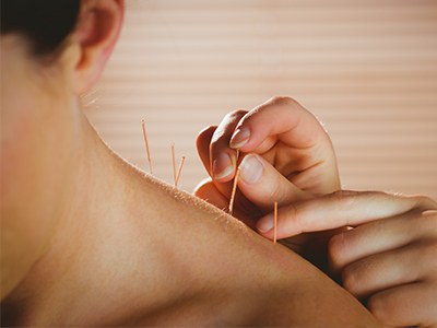Acupuncture needles being placed along a patient's shoulder